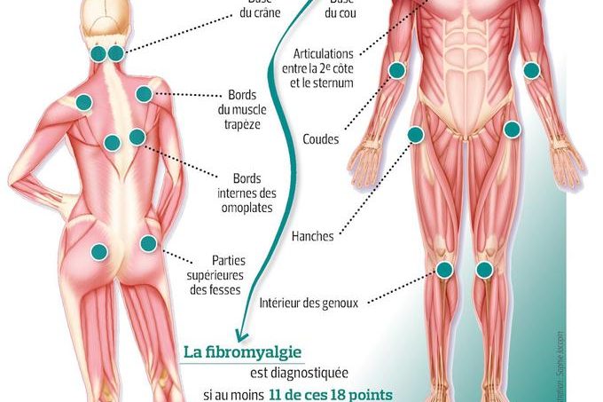 1.schéma fibromyalgie