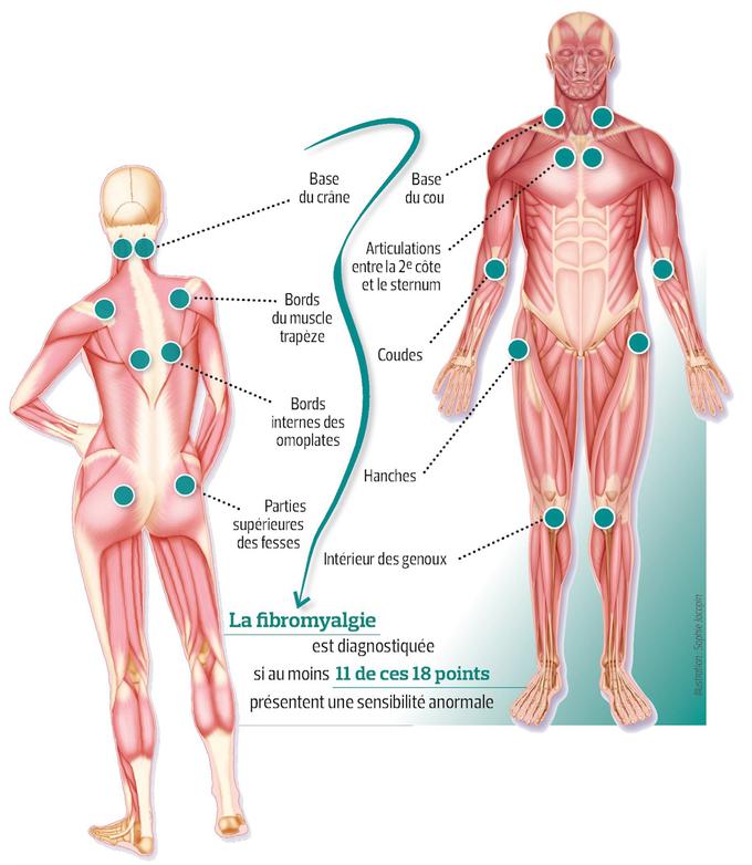 1.schéma fibromyalgie